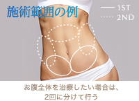 脂肪冷却 お腹の治療例