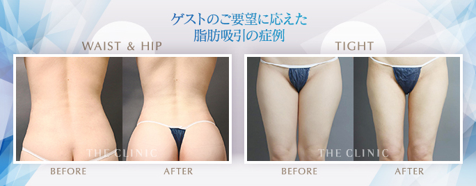 ゲストのご要望に応えた脂肪吸引の症例