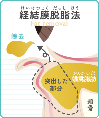 経結膜脱脂法