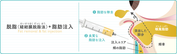 脱脂（経結膜脱脂法）+脂肪注入