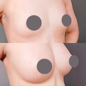 Aカップどこまで大きくなる？シリコンバッグ・脂肪注入・ハイブリッド豊胸の豊胸シミュレーション