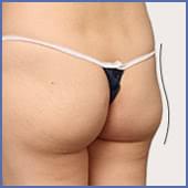 失敗症例から学ぶ、太もも脂肪吸引で後悔しないための3つのポイント