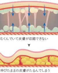 脂肪吸引後の圧迫固定の大切さ