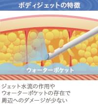 ボディジェット脂肪吸引の特徴