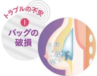授乳後豊胸の不安1:シリコンバッグの破損