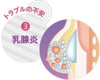 授乳後豊胸の不安3:乳腺炎