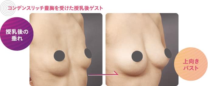 コンデンスリッチ豊胸を受けた授乳後のゲスト症例