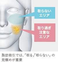 顔の脂肪吸引で必須となる、脂肪の見極め