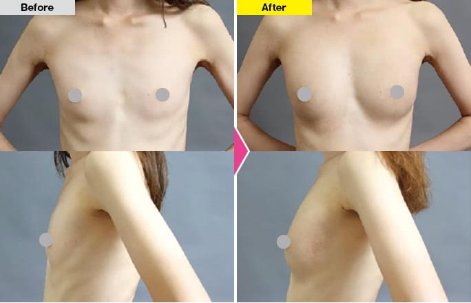 痩せ型の脂肪注入豊胸（乳房拡張期機の使用例）