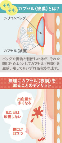 シリコンバッグのカプセル（被膜）とは