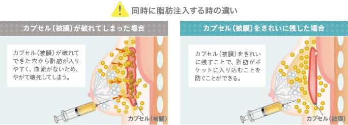 カプセル（被膜）の状態で異なる脂肪注入の効果