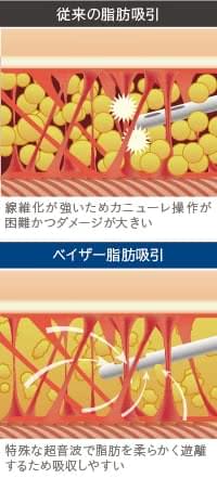 従来の脂肪吸引とベイザー脂肪吸引の性能を比較
