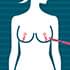 胸を小さくする手術【胸の脂肪吸引と乳房縮小術の違い】