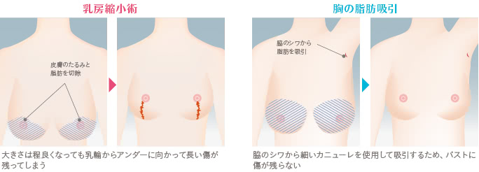 乳頭縮小術と胸の脂肪吸引による傷口の有無
