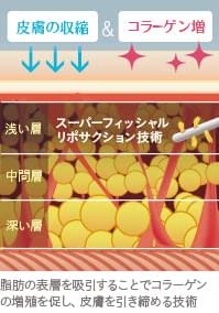 ベイザー脂肪吸引で得られる効果