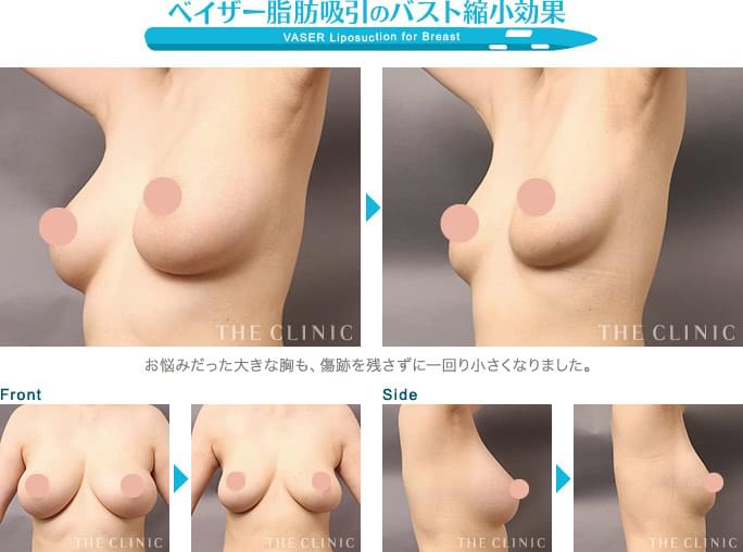 胸の脂肪吸引でバストを小さくした症例