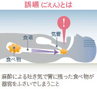 誤嚥（ごえん）とは