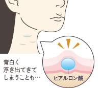 首にヒアルロン酸を注入した場合の図説