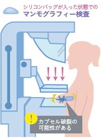 シリコンバッグが入った状態でのマンモグラフィー検査