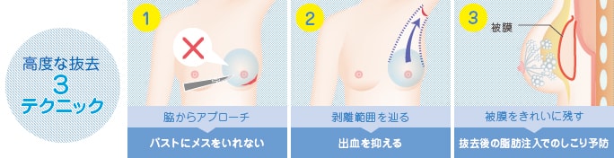 高度なシリコンバッグ抜去のテクニック