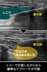 適切なしこり治療の例