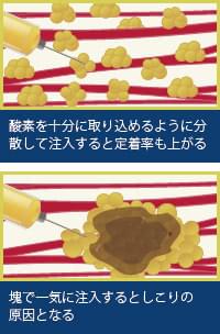 脂肪の定着率を高める方法