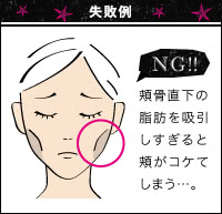 顔の脂肪吸引の失敗例