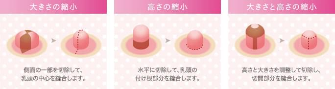 図説：乳頭縮小術の施術方法