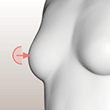 乳頭縮小