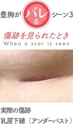 豊胸手術だとわかってしまうのはこんな時 3大施術のバレ度比較 美容外科の医師監修コラム