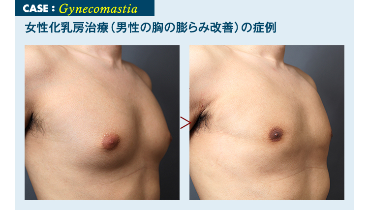 男性 メンズ 脂肪吸引モニターの実態調査 美容外科の医師監修コラム