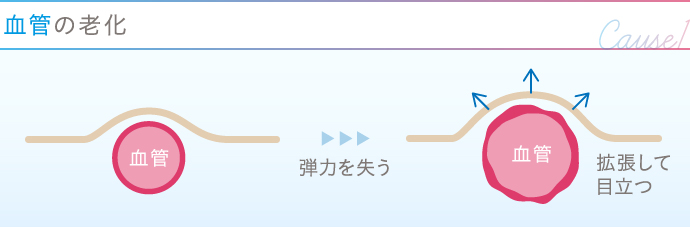 ハンドベインが改善 手の甲の浮き出る血管に新治療 医師監修コラム