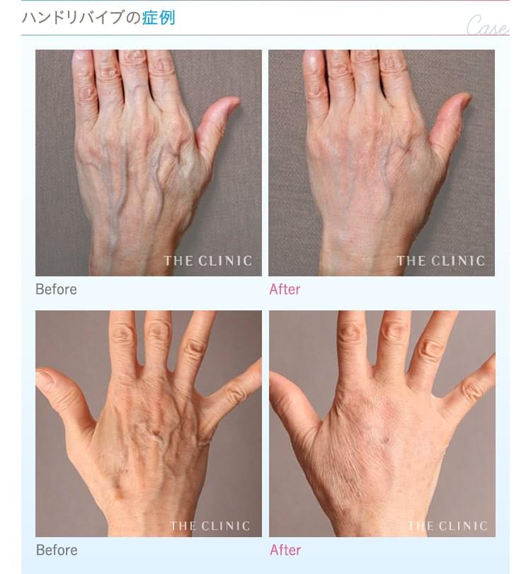 ハンドベイン 手のシワが改善 手の甲の浮き出る血管に新治療 美容外科の医師監修コラム ハンドベイン 手のシワが改善 手の甲の浮き出る血管に新治療 美容外科の医師監修コラム