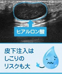 ヒアルロン酸豊胸の基礎知識 美容外科の医師監修コラム