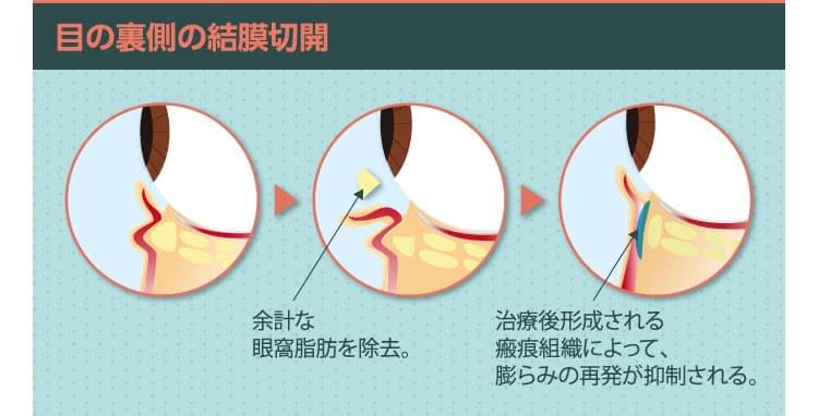 目の下のクマ たるみ取りのよくある失敗とその回避法 美容外科の医師監修コラム