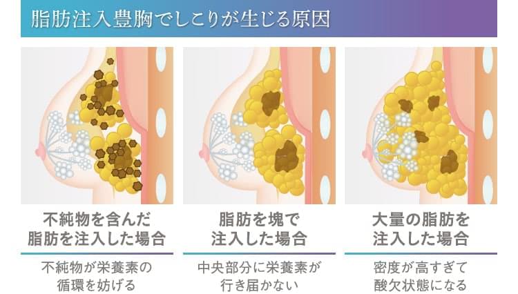 豊胸 脂肪注入の不安はこれで解決 全て丸わかりのq A 美容外科の医師監修コラム