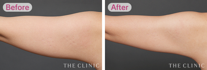 脂肪吸引 5つのデメリット 費用 リスク 痛み ダウンタイムについて 美容外科の医師監修コラム