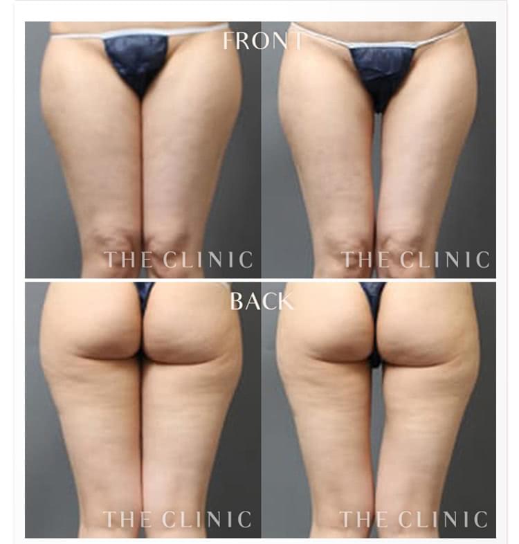 脂肪吸引の費用っていくら必要 部位別で料金をご紹介