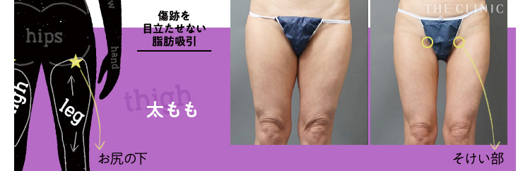 脂肪吸引はバレる 傷跡を残さない3つの工夫 美容外科の医師監修コラム