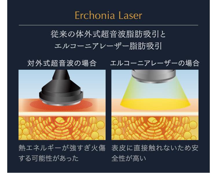 脂肪吸引の種類・方法を解説【ベイザーとアキーセルとエルサ（LSSA）の