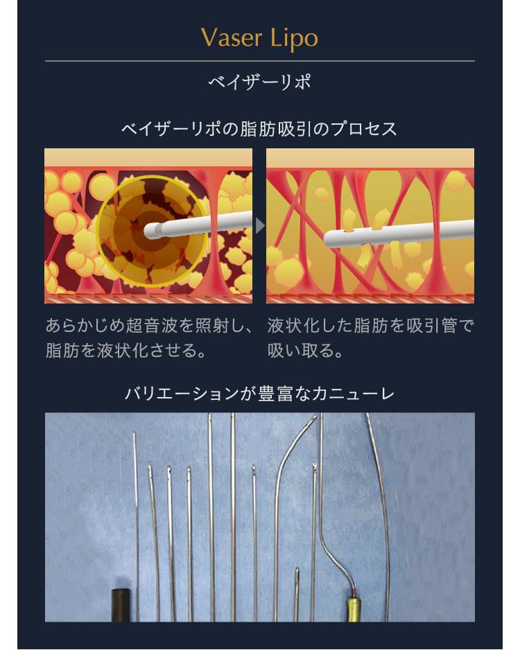 脂肪吸引の種類・方法を解説【ベイザーとアキーセルとエルサ（LSSA）の