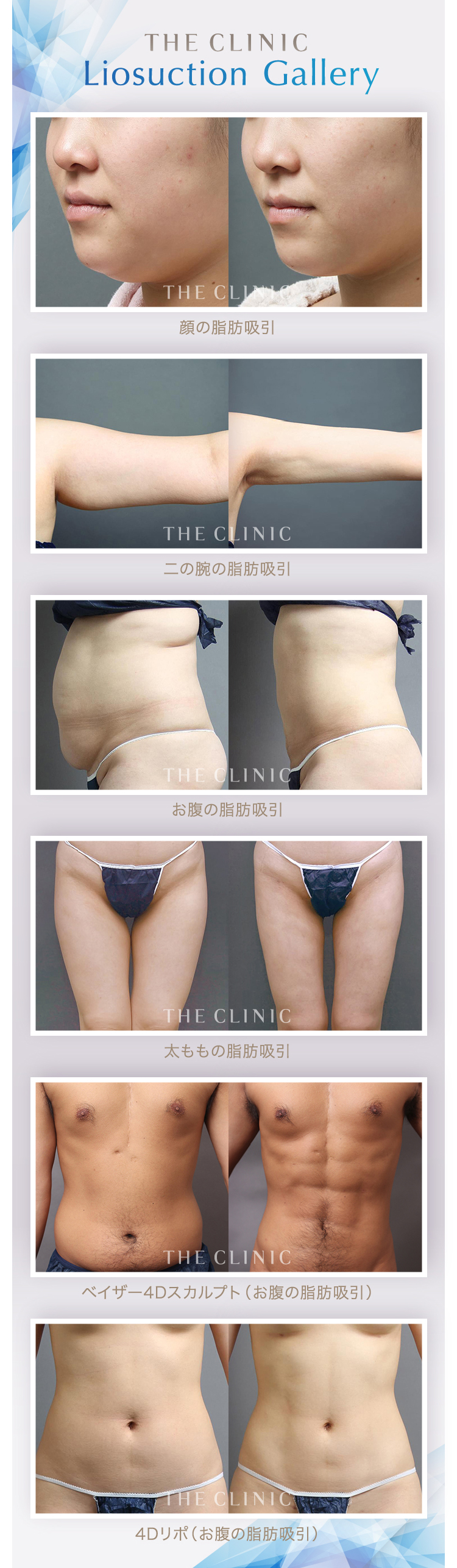 脂肪冷却の吸引カップ アタッチメント No.5 医療ダイエットの“お悩み別