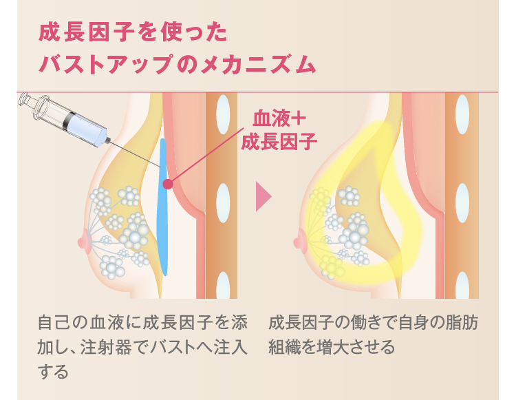 成長因子を使った再生豊胸の落とし穴 トラブル症例を画像と共に解説します