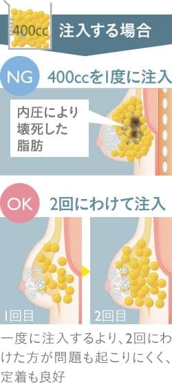 脂肪注入豊胸は定着するのか 脂肪注入後のバストの変化 医師監修コラム