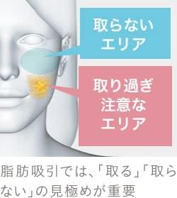 皮下脂肪 バッカルファット 選択ミスが小顔治療の失敗につながる 美容外科の医師監修コラム