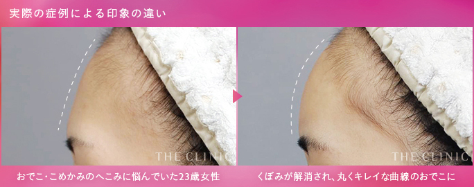 脂肪注入でおでこ（額）を丸くした例