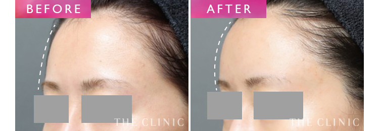 丸いおでこは美人の象徴 痩せた額をふっくらさせる方法 美容外科の医師監修コラム