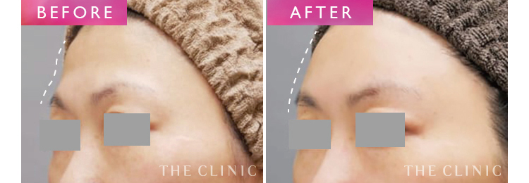 丸いおでこは美人の象徴 痩せた額をふっくらさせる方法 美容外科の医師監修コラム