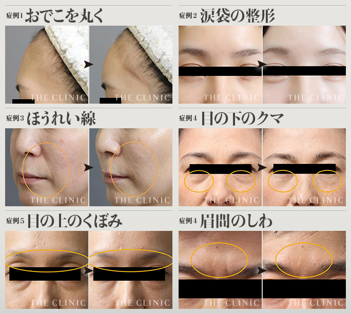 顔の脂肪注入の症例画像（おでこ・涙袋・ほうれい線・目の下のクマ・目の下のくぼみ・眉間のシワ）