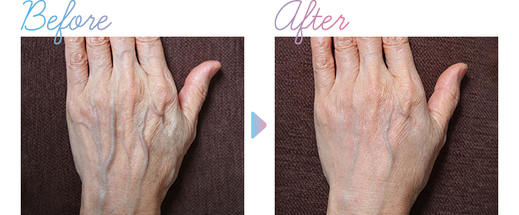 新治療 ハンドベイン 手のシワ 手の甲の浮き出る血管を改善する方法 美容外科の医師監修コラム